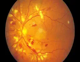 Hypertensive Retinopathy